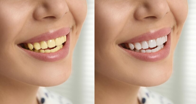 teeth-ew